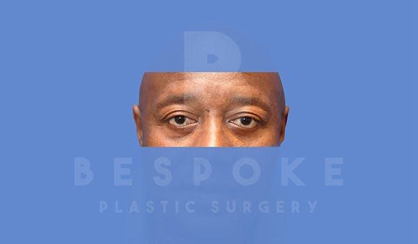 Male Eyelid Surgery Before & After Gallery - Patient 4819702 - Image 2