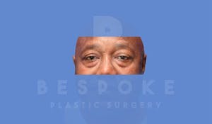 Male Eyelid Surgery