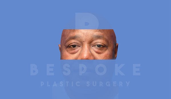 Male Eyelid Surgery Gallery - Patient 4819702 - Image 1