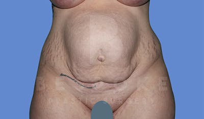 Massive Weight Loss Before & After Gallery - Patient 4842394 - Image 1