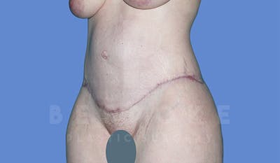 Massive Weight Loss Before & After Gallery - Patient 4842394 - Image 4
