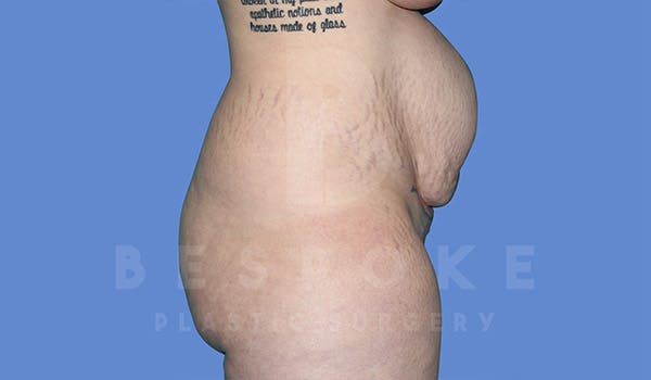 Massive Weight Loss Before & After Gallery - Patient 4842394 - Image 5