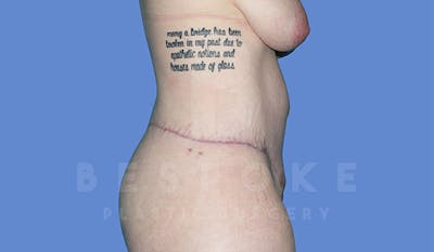 Massive Weight Loss Before & After Gallery - Patient 4842394 - Image 6