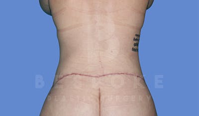 Massive Weight Loss Before & After Gallery - Patient 4842394 - Image 8