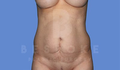 Tummy Tuck Before & After Gallery - Patient 4819904 - Image 1