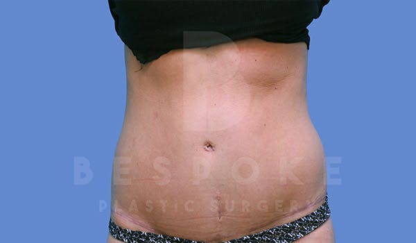 Tummy Tuck Before & After Gallery - Patient 4819904 - Image 2