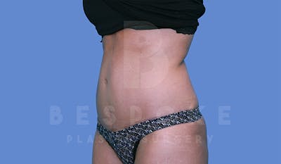 Tummy Tuck Before & After Gallery - Patient 4819904 - Image 4