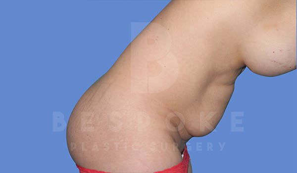 Tummy Tuck Before & After Gallery - Patient 4819904 - Image 5