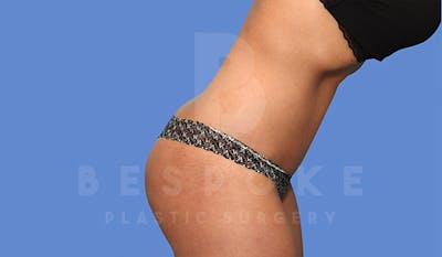 Tummy Tuck Before & After Gallery - Patient 4819904 - Image 6