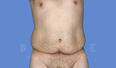 Massive Weight Loss Before & After Gallery - Patient 4819942 - Image 1