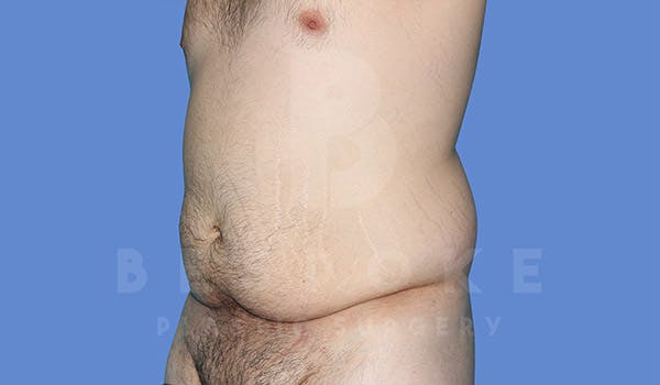 Massive Weight Loss Before & After Gallery - Patient 4819942 - Image 3