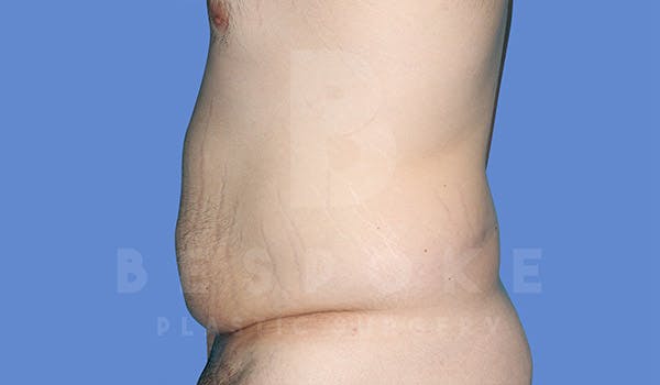 Massive Weight Loss Before & After Gallery - Patient 4819942 - Image 5