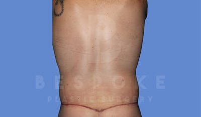Massive Weight Loss Before & After Gallery - Patient 4819942 - Image 10