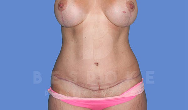 Mommy Makeover Before & After Gallery - Patient 4819983 - Image 4