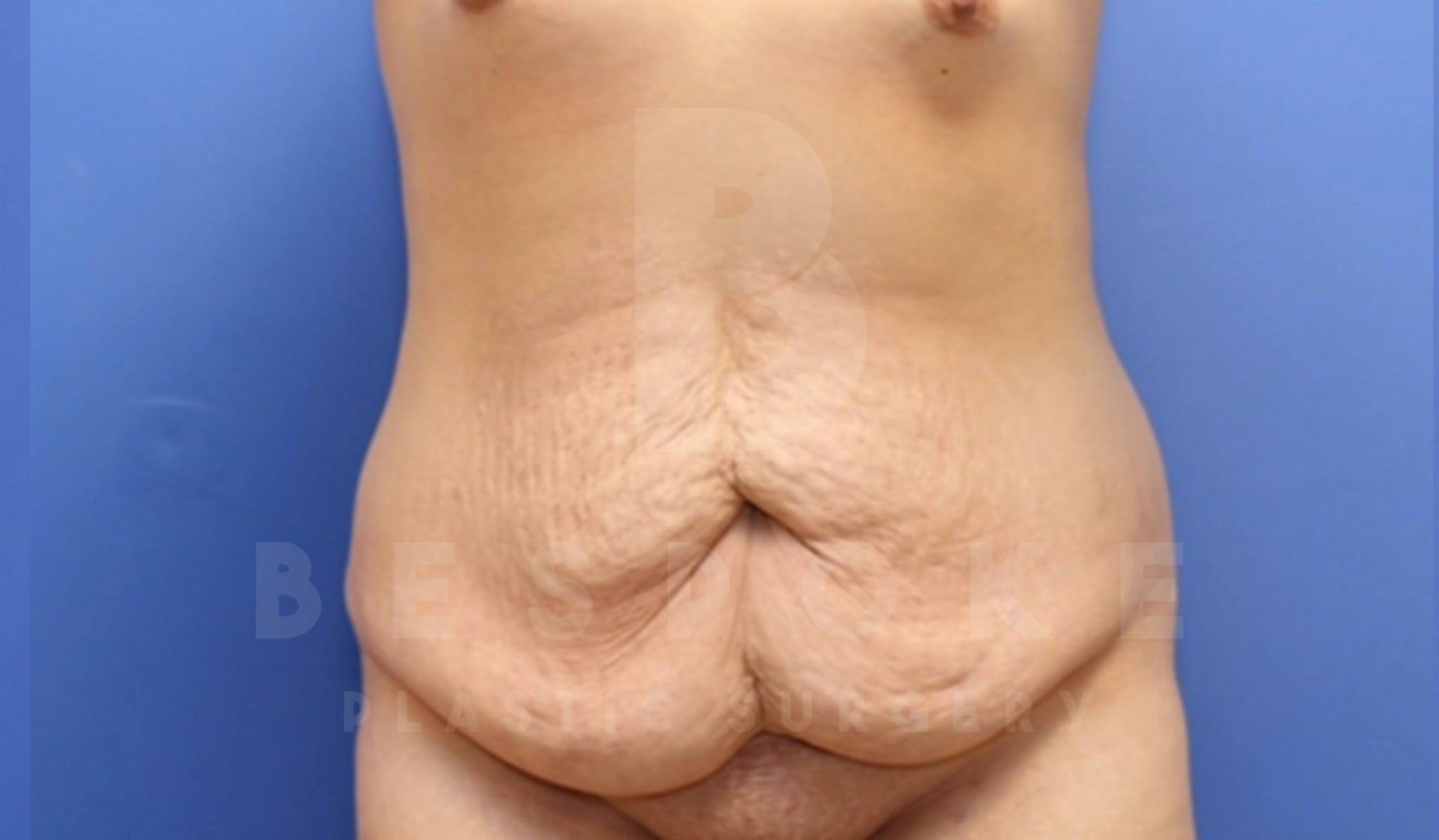 Tummy Tuck Before & After Gallery - Patient 4878087 - Image 1