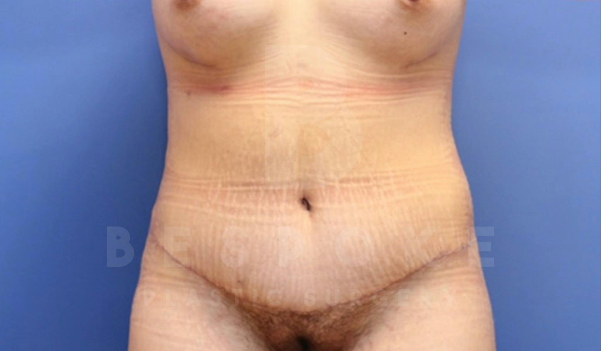 Tummy Tuck Before & After Gallery - Patient 4878087 - Image 2