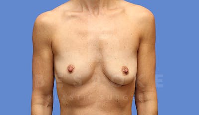Breast Augmentation Before & After Gallery - Patient 5040798 - Image 1