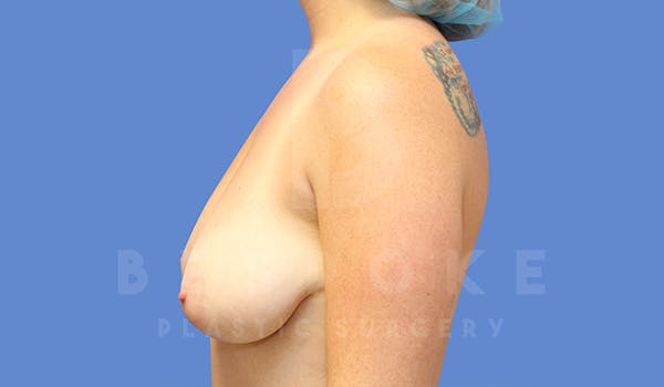 Breast Lift With Implants Before & After Gallery - Patient 5040799 - Image 5
