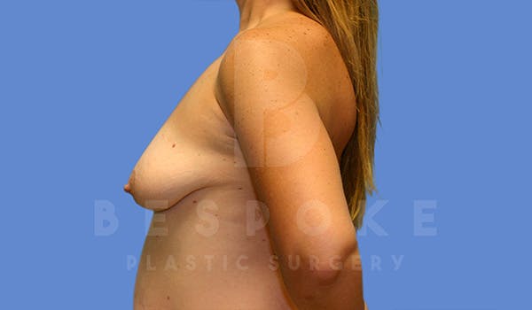 Breast Lift With Implants Before & After Gallery - Patient 5040801 - Image 5