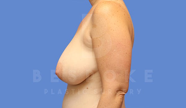 Breast Lift (No Implants) Before & After Gallery - Patient 5040805 - Image 5