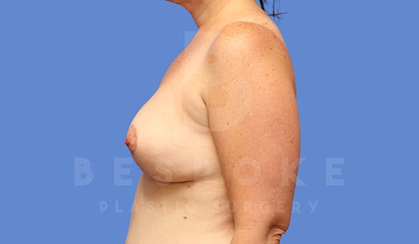 Breast Lift (No Implants) Before & After Gallery - Patient 5040805 - Image 6