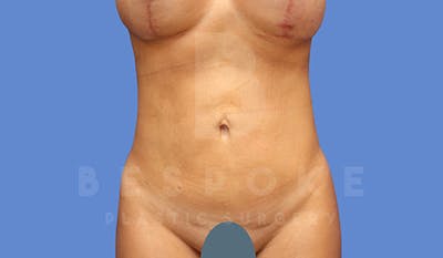 High Def Lipo Before & After Gallery - Patient 5040806 - Image 4