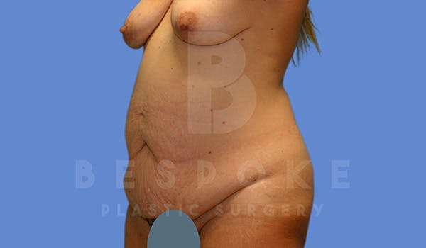 Mommy Makeover Before & After Gallery - Patient 5040809 - Image 7