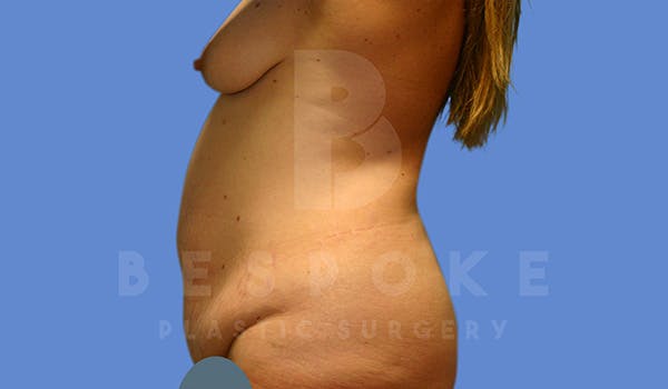Mommy Makeover Before & After Gallery - Patient 5040809 - Image 9