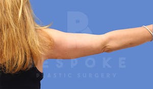 Charlotte NC Arm Lift Results