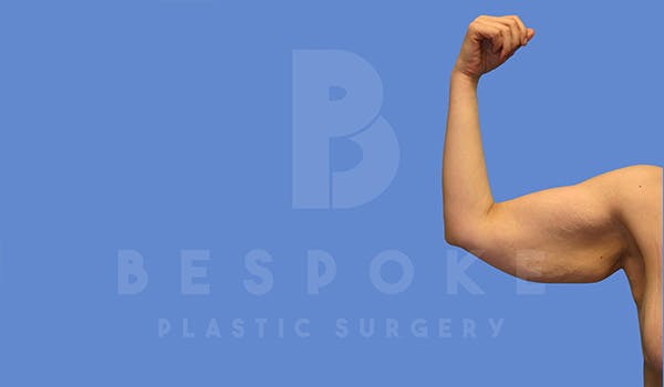 Massive Weight Loss Before & After Gallery - Patient 5040812 - Image 3