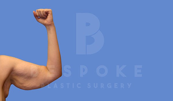 Massive Weight Loss Before & After Gallery - Patient 5040812 - Image 5