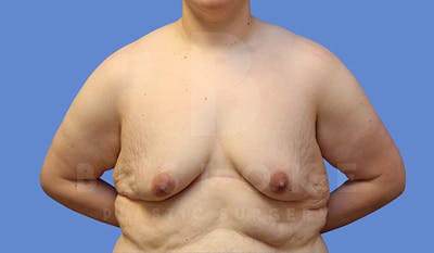 Breast Lift With Implants Before & After Gallery - Patient 5089516 - Image 1