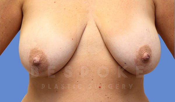 Breast Lift With Implants Before & After Gallery - Patient 5089517 - Image 1