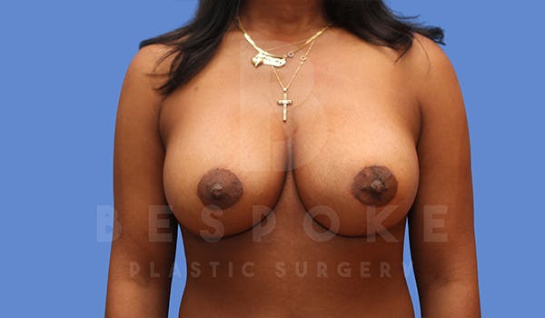 Breast Lift With Implants Before & After Gallery - Patient 5089518 - Image 2