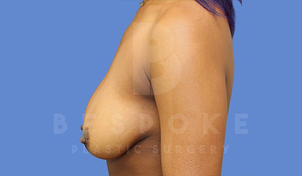 Breast Lift With Implants Before & After Gallery - Patient 5089518 - Image 5