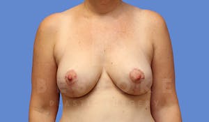 Charlotte NC Breast Augmentation with Lift Results