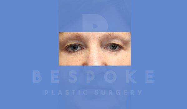 Eyelid Surgery Gallery - Patient 5089842 - Image 2