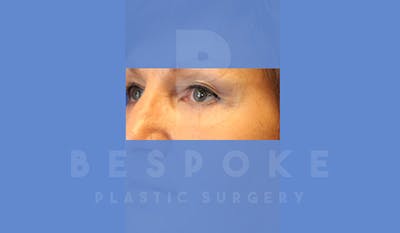 Eyelid Surgery Gallery - Patient 5089842 - Image 4