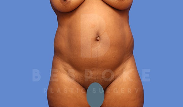 Liposuction Before & After Gallery - Patient 5089891 - Image 1