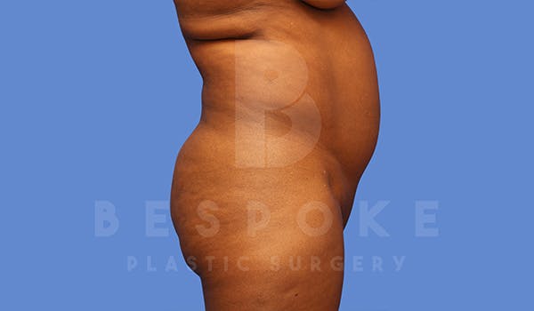 Liposuction Before & After Gallery - Patient 5089891 - Image 3