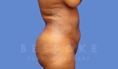Liposuction Before & After Gallery - Patient 5089891 - Image 4