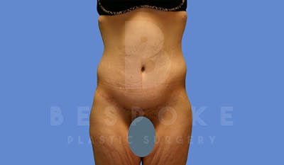 Massive Weight Loss Before & After Gallery - Patient 5089950 - Image 2