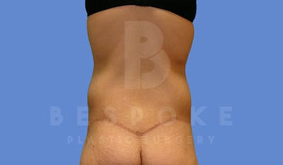 Massive Weight Loss Before & After Gallery - Patient 5089950 - Image 4