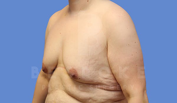 Massive Weight Loss Before & After Gallery - Patient 5089951 - Image 3