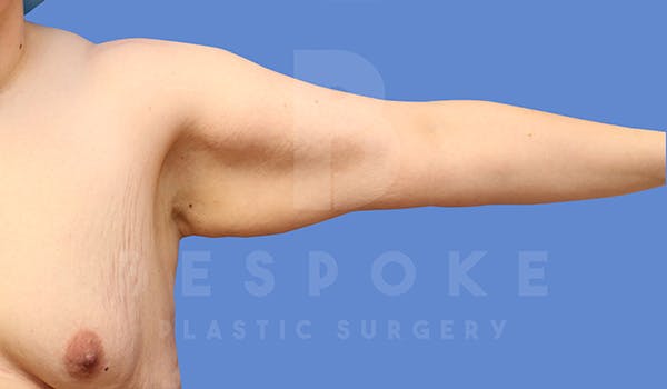 Massive Weight Loss Before & After Gallery - Patient 5089952 - Image 3
