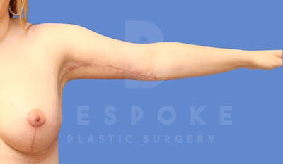 Massive Weight Loss Before & After Gallery - Patient 5089952 - Image 4