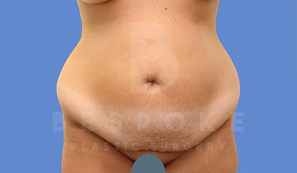 Mommy Makeover Before & After Gallery - Patient 5090011 - Image 5