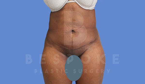 Before and After Mini Tummy Tuck in Charlotte, NC