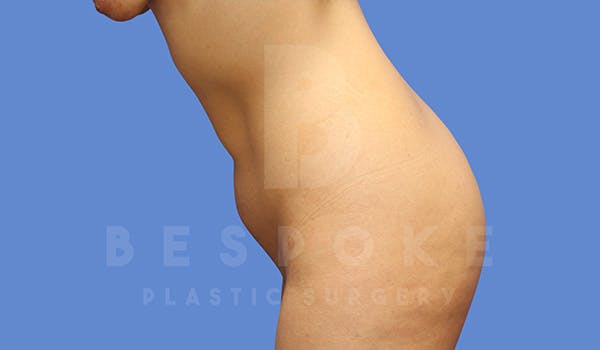 Petite Tuck Before & After Gallery - Patient 5090113 - Image 3