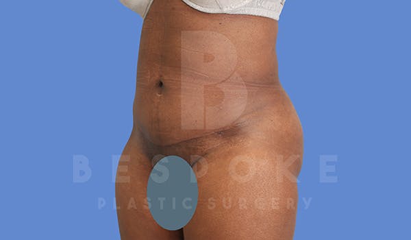 Petite Tuck Before & After Gallery - Patient 5090112 - Image 4